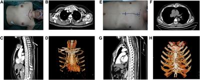 Primary sternal tumour resection and reconstruction with LARS mesh-bone cement sandwich by 3D-printing: Case reports